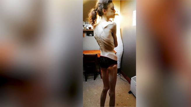 go to Anorexie besiegt: Emille kämpft sich zurück ins Leben